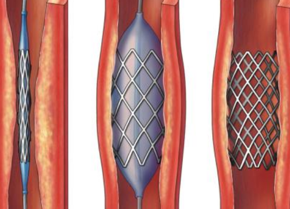 好消息！700元冠脈支架來(lái)了帶量采購(gòu)結(jié)果在甘肅省正式落地執(zhí)行